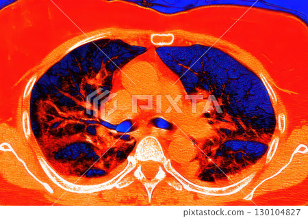 Lungs with COVID-19 pneumonia, color-enhanced CT scan showing normal lung tissue in dark blue and affected bilateral areas with ground-glass opacities and crazy-paving patterns in red 130104827