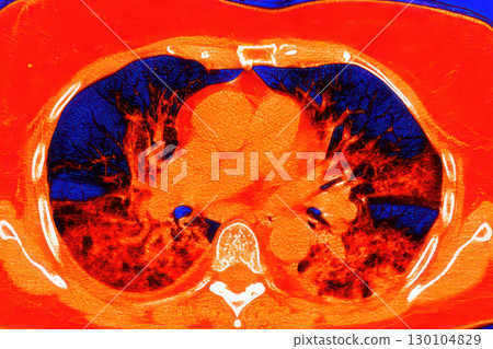Lungs with COVID-19 pneumonia, color-enhanced CT scan showing normal lung tissue in dark blue and affected bilateral areas with ground-glass opacities and crazy-paving patterns in red 130104829