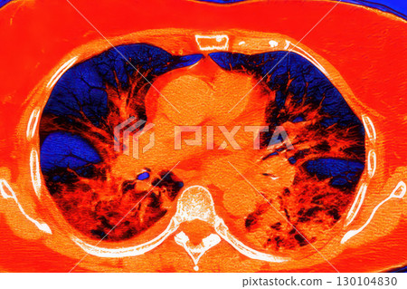 Lungs with COVID-19 pneumonia, color-enhanced CT scan showing normal lung tissue in dark blue and affected bilateral areas with ground-glass opacities and crazy-paving patterns in red 130104830