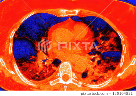 Lungs with COVID-19 pneumonia, color-enhanced CT scan showing normal lung tissue in dark blue and affected bilateral areas with ground-glass opacities and crazy-paving patterns in red 130104831
