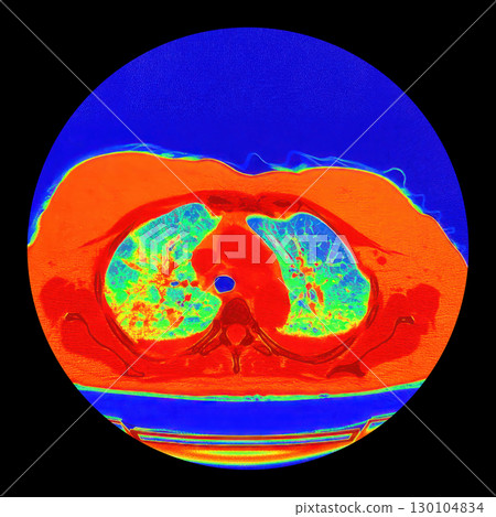 Lungs with COVID-19 pneumonia, color-enhanced CT scan showing normal lung tissue in blue-green and affected bilateral areas with ground-glass opacities and crazy-paving patterns in orange-red 130104834