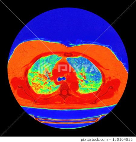 Lungs with COVID-19 pneumonia, color-enhanced CT scan showing normal lung tissue in blue-green and affected bilateral areas with ground-glass opacities and crazy-paving patterns in orange-red 130104835
