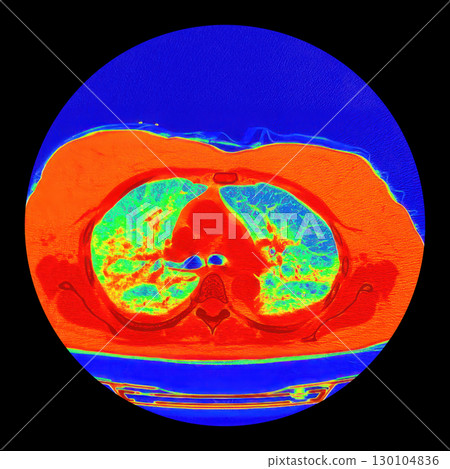 Lungs with COVID-19 pneumonia, color-enhanced CT scan showing normal lung tissue in blue-green and affected bilateral areas with ground-glass opacities and crazy-paving patterns in orange-red 130104836