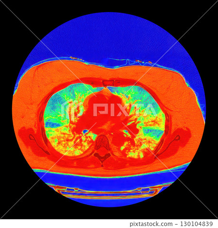 Lungs with COVID-19 pneumonia, color-enhanced CT scan showing normal lung tissue in blue-green and affected bilateral areas with ground-glass opacities and crazy-paving patterns in orange-red 130104839