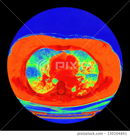 Lungs with COVID-19 pneumonia, color-enhanced CT scan showing normal lung tissue in blue-green and affected bilateral areas with ground-glass opacities and crazy-paving patterns in orange-red 130104841