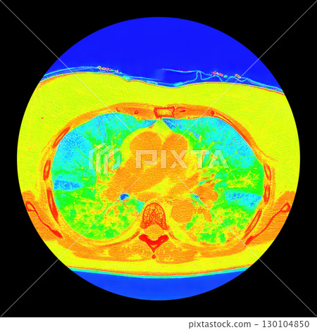 Lungs with COVID-19 pneumonia, color-enhanced CT scan showing normal lung tissue in blue and affected bilateral areas with ground-glass opacities and crazy-paving patterns in green to yellow 130104850