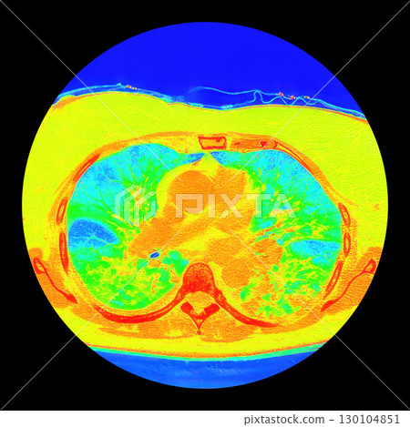 Lungs with COVID-19 pneumonia, color-enhanced CT scan showing normal lung tissue in blue and affected bilateral areas with ground-glass opacities and crazy-paving patterns in green to yellow 130104851