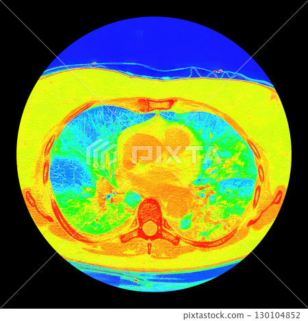 Lungs with COVID-19 pneumonia, color-enhanced CT scan showing normal lung tissue in blue and affected bilateral areas with ground-glass opacities and crazy-paving patterns in green to yellow 130104852