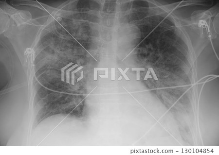 Human lungs with COVID-19 pneumonia, chest X-ray showing bilateral lung infiltrates with interstitial opacities 130104854