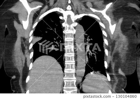 CT scan showing wedge-shaped pulmonary infarction in right lung of a patient with pulmonary embolism 130104860