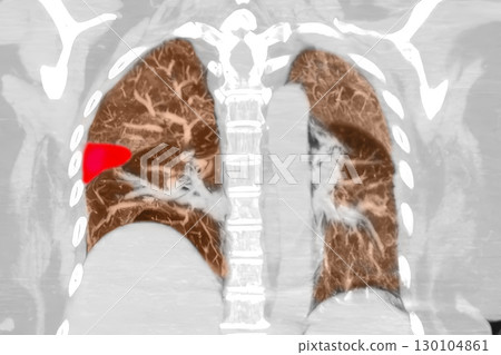 Color-enhanced CT scan showing wedge-shaped pulmonary infarction in right lung of a patient with pulmonary embolism Color-enhanced CT scan showing wedge-shaped pulmonary infarction in right lung of a patient with pulmonary embolism 130104861