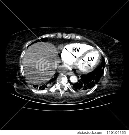 CT scan showing right ventricular strain in a patient with pulmonary embolism, highlighting right ventricular enlargement and flattening of the interventricular septum CT scan showing right ventricular strain in a patient with pulmonary embolism, highlighting right ventricular enlargement and flattening of the interventricular septum 130104863