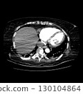 CT scan showing right ventricular strain in a patient with pulmonary embolism, highlighting right ventricular enlargement and flattening of the interventricular septum 130104864