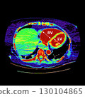 CT scan showing right ventricular strain in a patient with pulmonary embolism, highlighting right ventricular enlargement and flattening of the interventricular septum 130104865