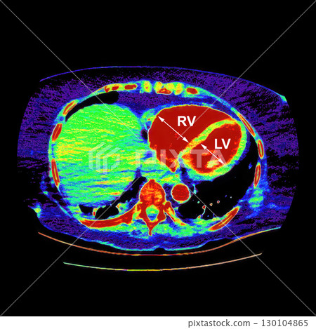CT scan showing right ventricular strain in a patient with pulmonary embolism, highlighting right ventricular enlargement and flattening of the interventricular septum CT scan showing right ventricular strain in a patient with pulmonary embolism, highlighting right ventricular enlargement and flattening of the interventricular septum 130104865