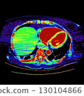 CT scan showing right ventricular strain in a patient with pulmonary embolism, highlighting right ventricular enlargement and flattening of the interventricular septum 130104866