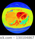 CT scan showing right ventricular strain in a patient with pulmonary embolism, highlighting right ventricular enlargement and flattening of the interventricular septum 130104867