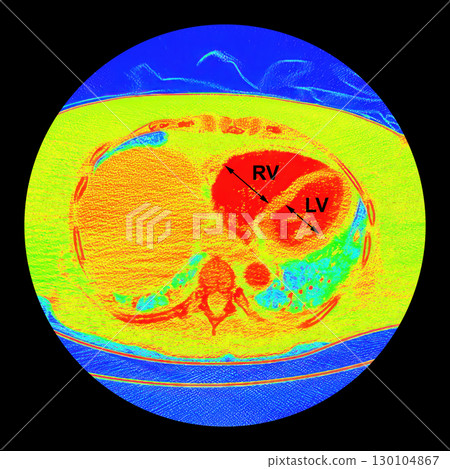CT scan showing right ventricular strain in a patient with pulmonary embolism, highlighting right ventricular enlargement and flattening of the interventricular septum 130104867