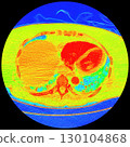 CT scan showing right ventricular strain in a patient with pulmonary embolism, highlighting right ventricular enlargement and flattening of the interventricular septum 130104868