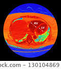 CT scan showing right ventricular strain in a patient with pulmonary embolism, highlighting right ventricular enlargement and flattening of the interventricular septum 130104869