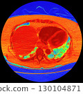 CT scan showing right ventricular strain in a patient with pulmonary embolism, highlighting right ventricular enlargement and flattening of the interventricular septum 130104871