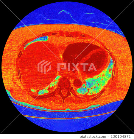 CT scan showing right ventricular strain in a patient with pulmonary embolism, highlighting right ventricular enlargement and flattening of the interventricular septum 130104871