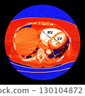 CT scan showing right ventricular strain in a patient with pulmonary embolism, highlighting right ventricular enlargement and flattening of the interventricular septum 130104872