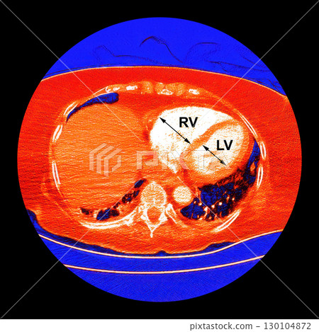 CT scan showing right ventricular strain in a patient with pulmonary embolism, highlighting right ventricular enlargement and flattening of the interventricular septum 130104872