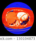 CT scan showing right ventricular strain in a patient with pulmonary embolism, highlighting right ventricular enlargement and flattening of the interventricular septum 130104873