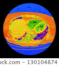 CT scan showing right ventricular strain in a patient with pulmonary embolism, highlighting right ventricular enlargement and flattening of the interventricular septum 130104874
