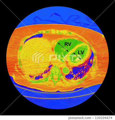 CT scan showing right ventricular strain in a patient with pulmonary embolism, highlighting right ventricular enlargement and flattening of the interventricular septum CT scan showing right ventricular strain in a patient with pulmonary embolism, highlighting right ventricular enlargement and flattening of the interventricular septum 130104874