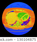 CT scan showing right ventricular strain in a patient with pulmonary embolism, highlighting right ventricular enlargement and flattening of the interventricular septum 130104875