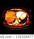 CT scan showing right ventricular strain in a patient with pulmonary embolism, highlighting right ventricular enlargement and flattening of the interventricular septum 130104877
