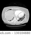 CT scan showing right ventricular strain in a patient with pulmonary embolism, highlighting right ventricular enlargement and flattening of the interventricular septum 130104880