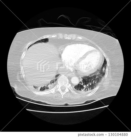 CT scan showing right ventricular strain in a patient with pulmonary embolism, highlighting right ventricular enlargement and flattening of the interventricular septum 130104880