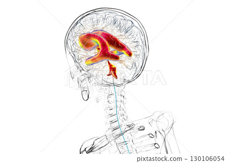 Normal pressure hydrocephalus, 3D illustration 130106054