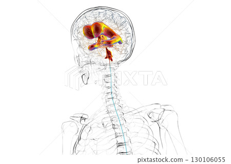 Normal pressure hydrocephalus, 3D illustration 130106055