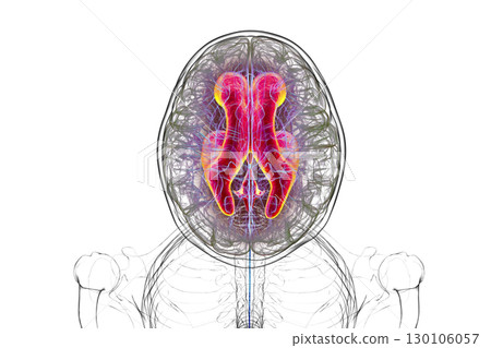 Normal pressure hydrocephalus, 3D illustration 130106057
