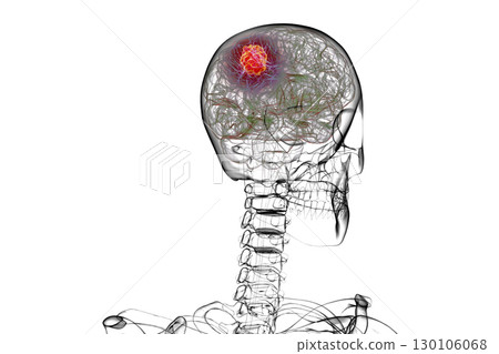 Brain tumor, 3D illustration 130106068