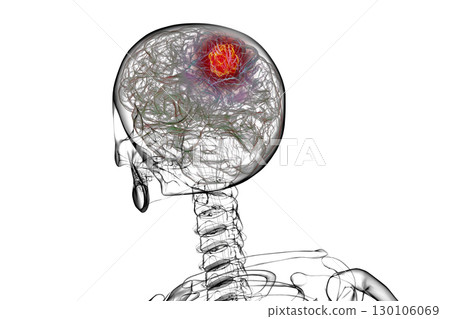 Brain tumor, 3D illustration 130106069