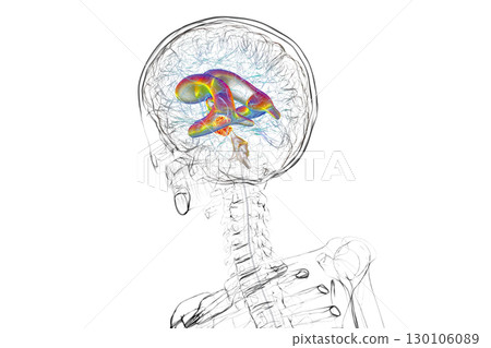 A brain tumor causing hydrocephalus, 3D illustration A brain tumor causing hydrocephalus, 3D illustration 130106089