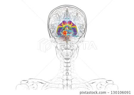 A brain tumor causing hydrocephalus, 3D illustration 130106091