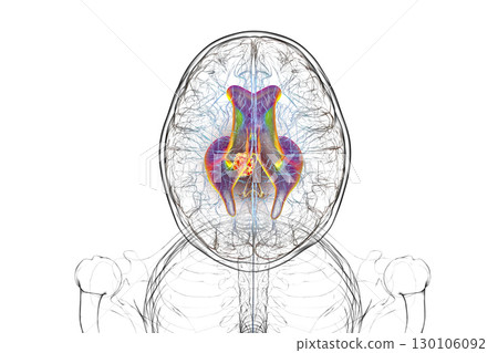 A brain tumor causing hydrocephalus, 3D illustration A brain tumor causing hydrocephalus, 3D illustration 130106092