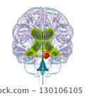 A brain tumor causing hydrocephalus, 3D illustration 130106105