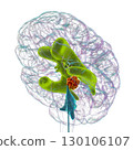 A brain tumor causing hydrocephalus, 3D illustration 130106107