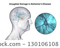 Alzheimer's disease, 3D illustration 130106108