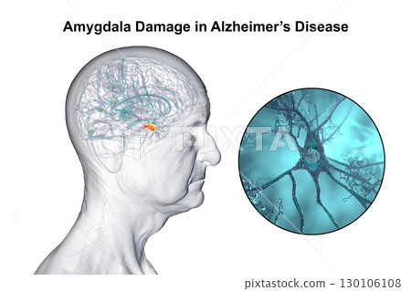 Alzheimer's disease, 3D illustration 130106108