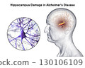 Alzheimer's disease, 3D illustration 130106109