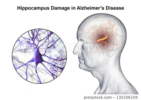 Alzheimer's disease, 3D illustration 130106109