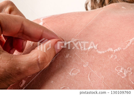 Peeling Skin After Sunburn on Shoulder, Close-Up Showing Healing Process and Sun Damage 130109760